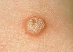 How to remove warts